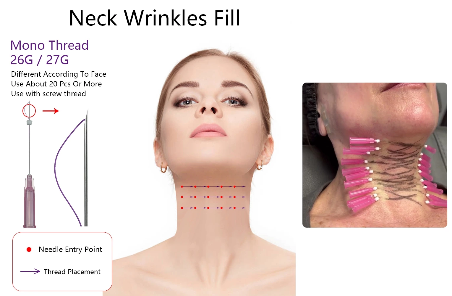 Skin Filling Smooth PDO Mono Thread