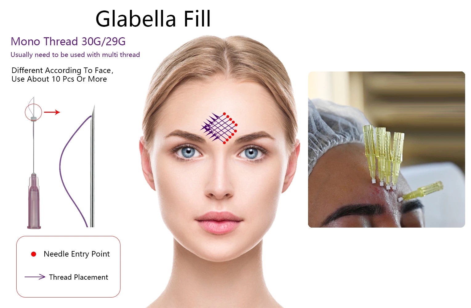 Skin Filling Smooth PDO Mono Thread