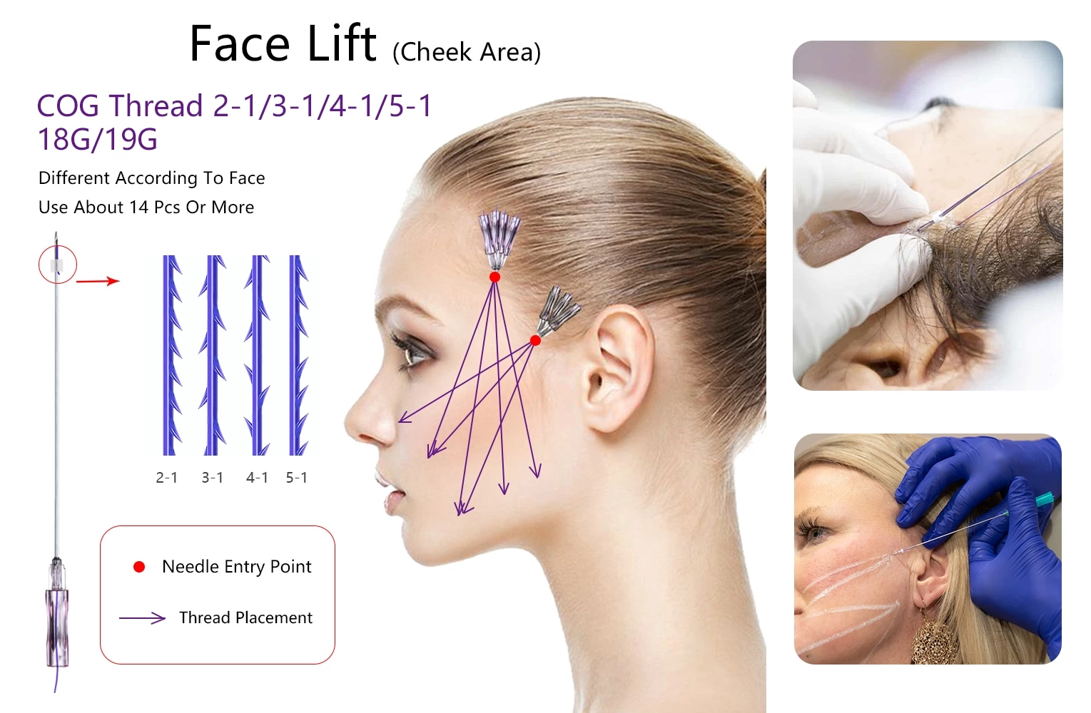 Face Lift PDO 2-1 3-1 4-1 5-1  Thread
