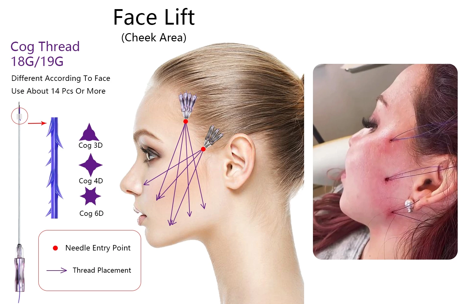 Face Lifting 3d 6d 8d 12d PDO Thread