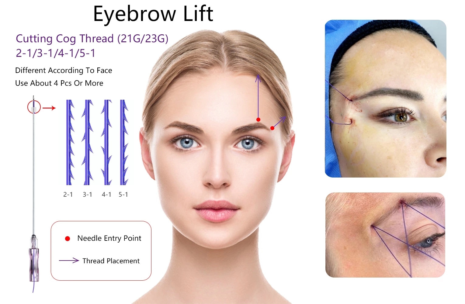 Face Lift PDO 2-1 3-1 4-1 5-1  Thread