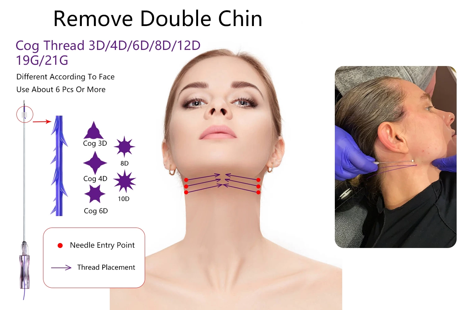 Face Lifting 3d 6d 8d 12d PDO Thread