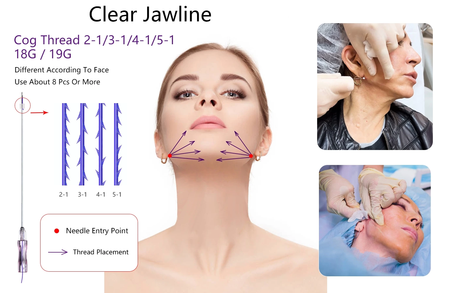 Face Lift PDO 2-1 3-1 4-1 5-1  Thread