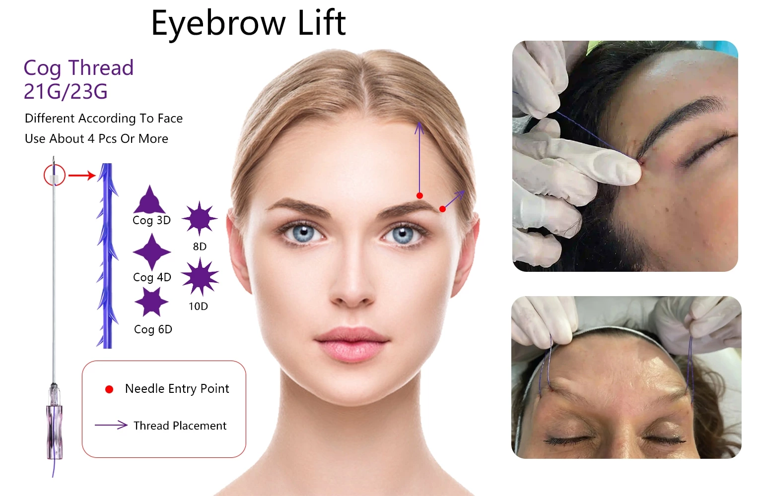 Face Lifting 3d 6d 8d 12d PDO Thread