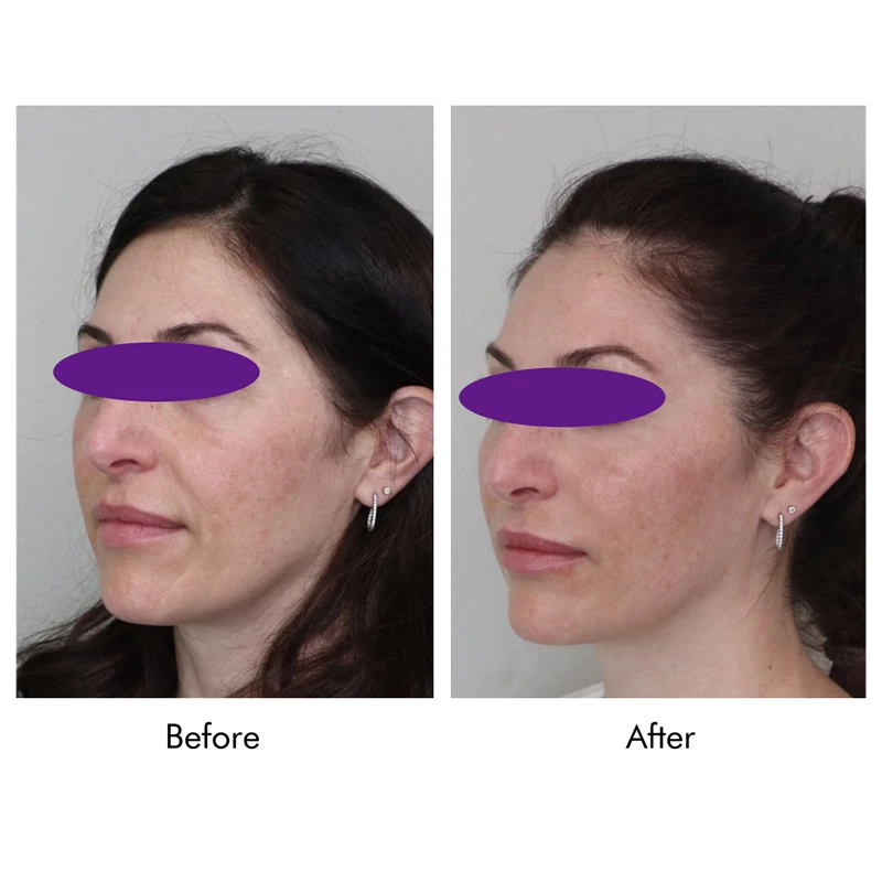 Skin Filling Smooth PDO Mono Thread