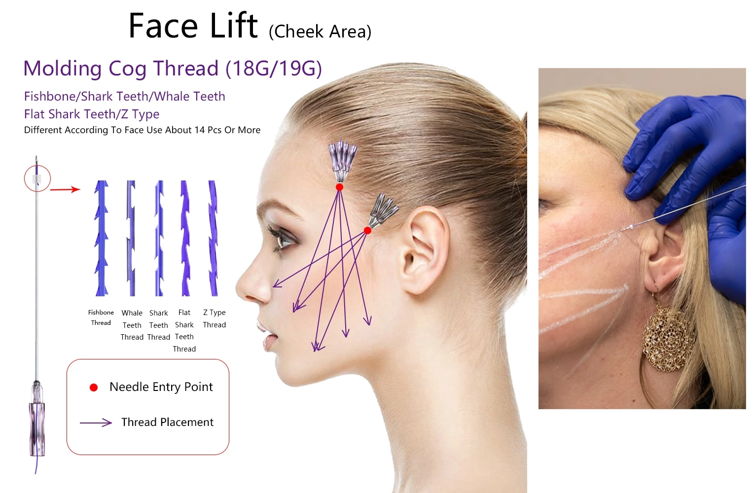 Face Lifting PDO Molding Thread