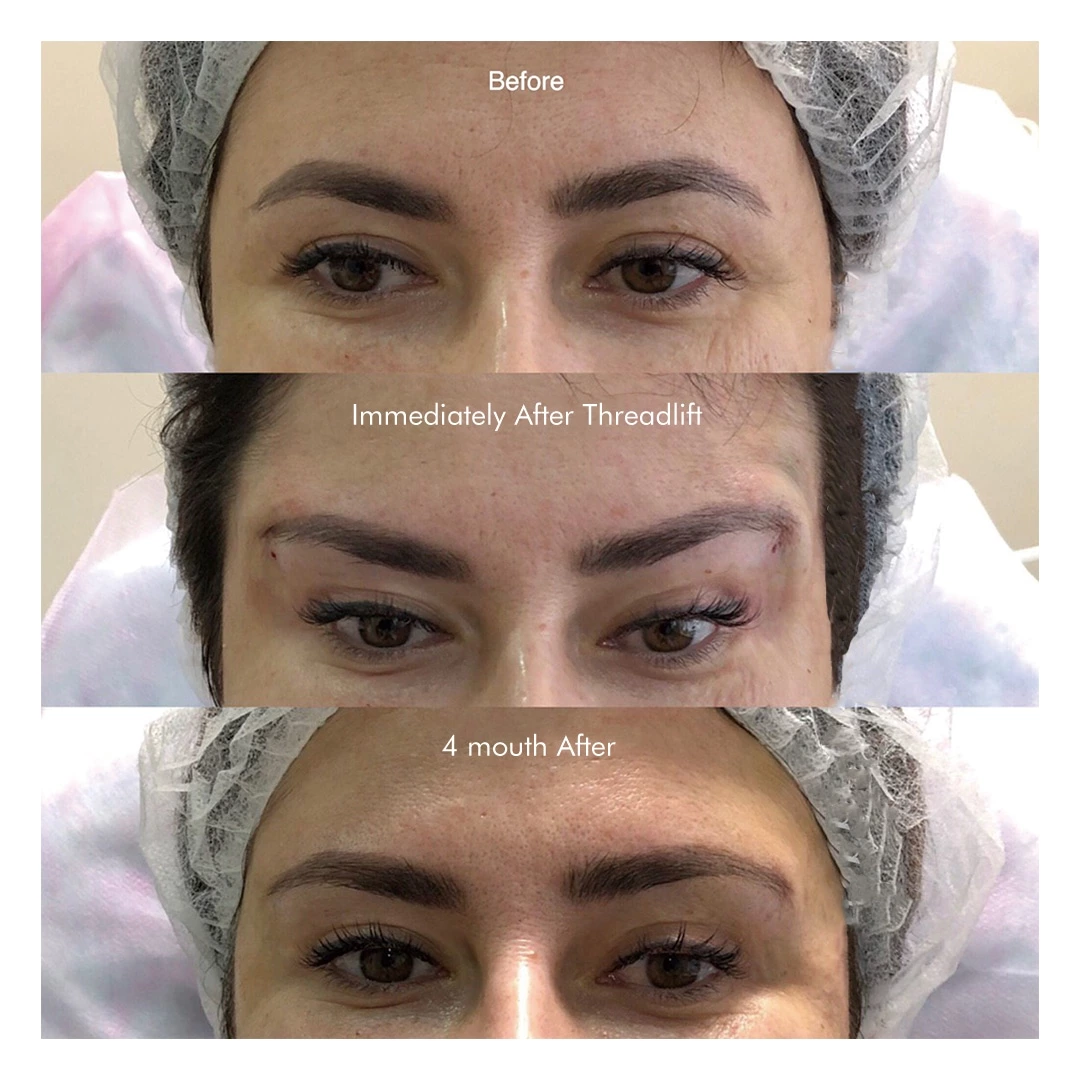 Face Lift PDO 2-1 3-1 4-1 5-1  Thread