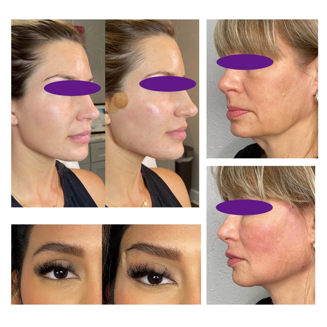 Face Lifting 3d 6d 8d 12d PDO Thread