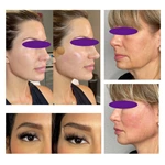 Face Lifting 3d 6d 8d 12d PDO Thread
