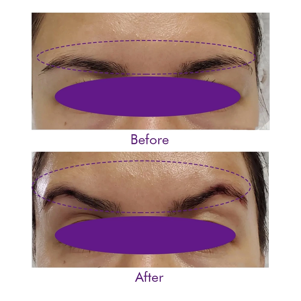 Face Lift PDO 2-1 3-1 4-1 5-1  Thread