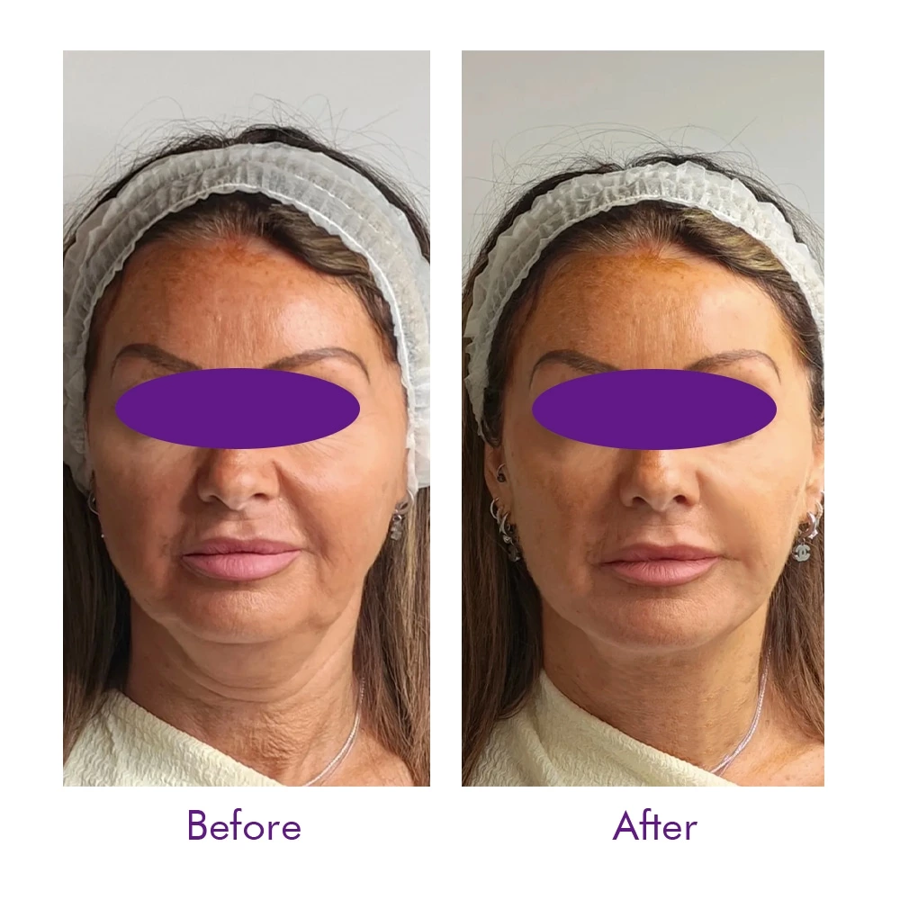Face Lift PDO 2-1 3-1 4-1 5-1  Thread