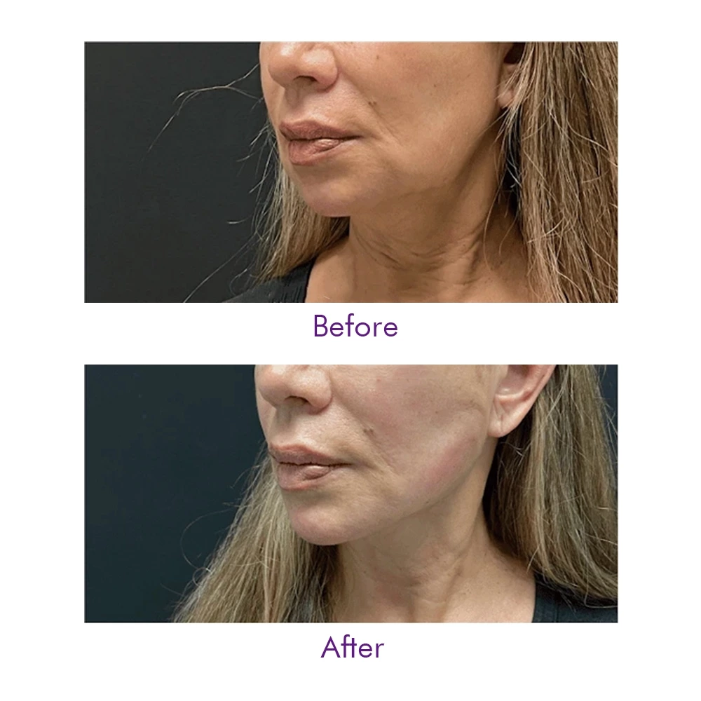 Face Lift PDO 2-1 3-1 4-1 5-1  Thread