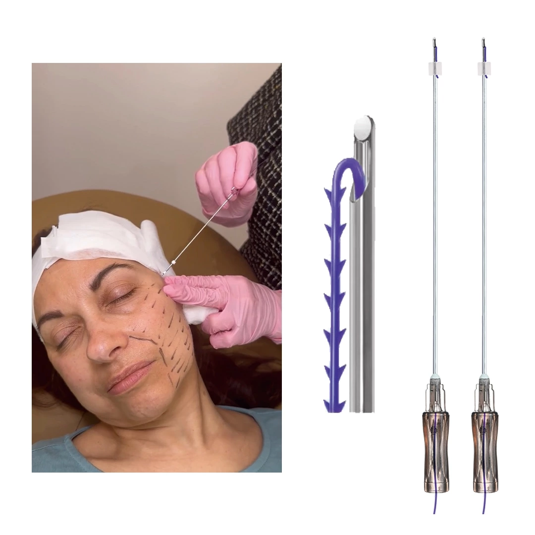 Face Lifting PDO Molding Thread