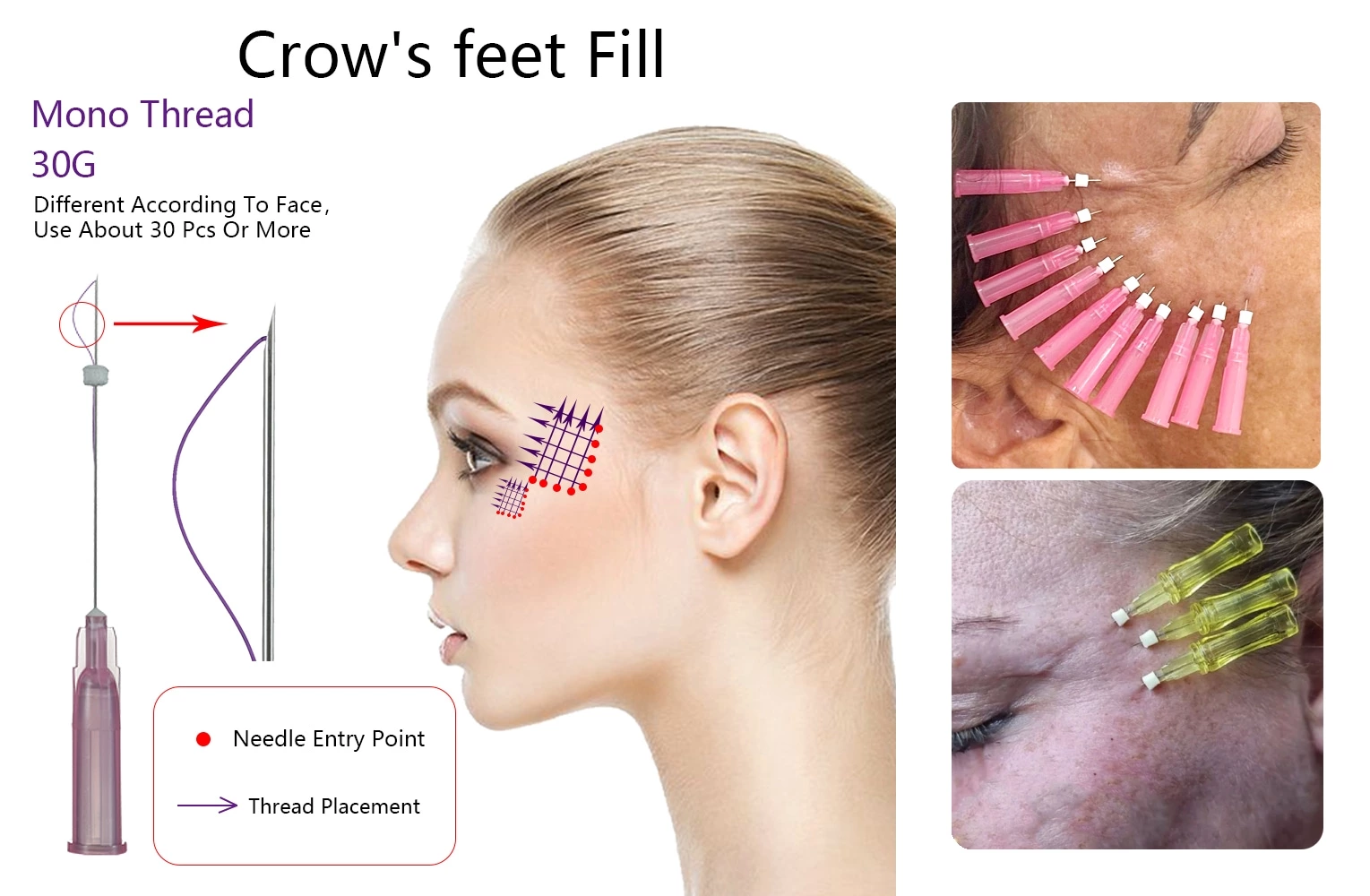 Skin Filling Smooth PDO Mono Thread