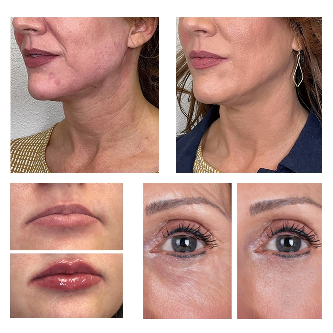 Skin Filling Smooth PDO Mono Thread