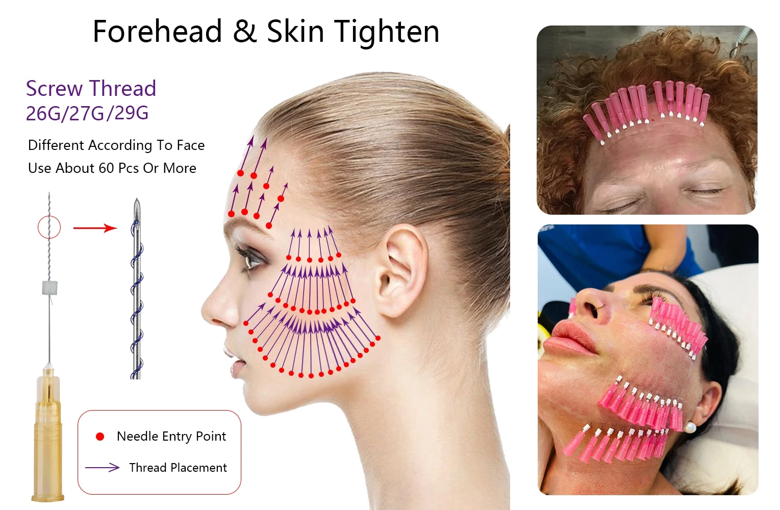 Skin Tightening PDO Screw Thread