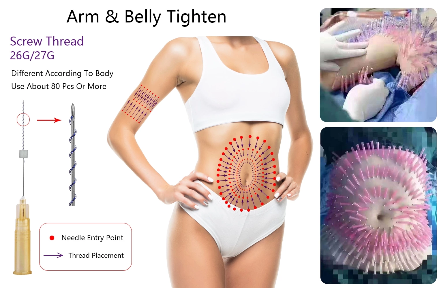 Skin Tightening PDO Screw Thread