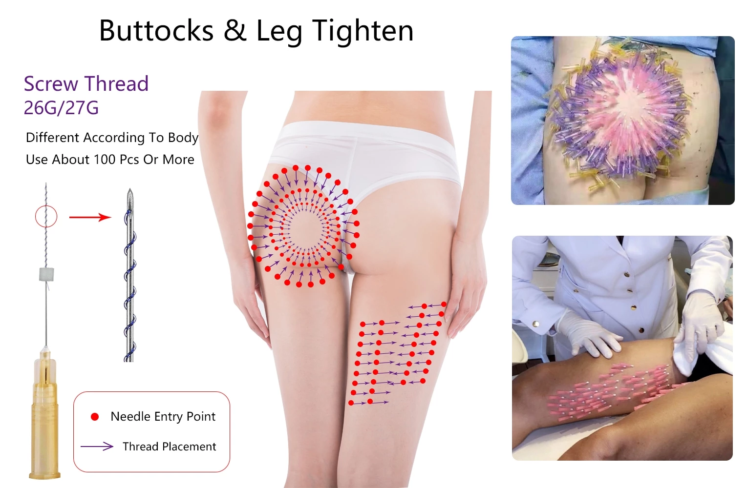 Skin Tightening PDO Screw Thread