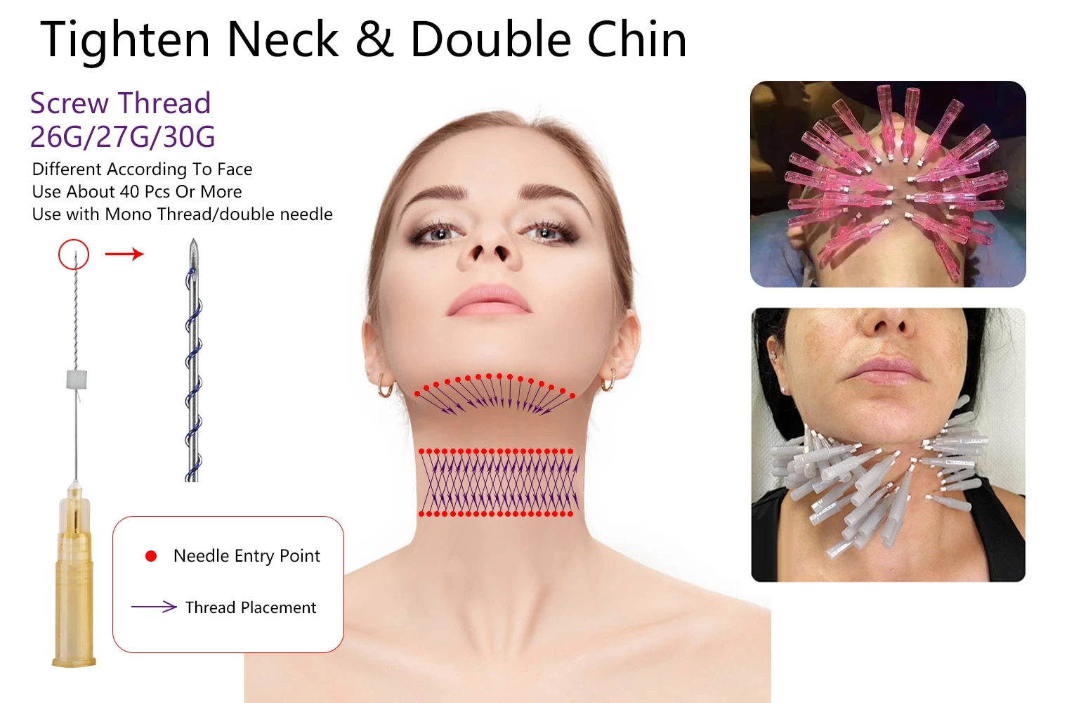 Skin Tightening PDO Screw Thread