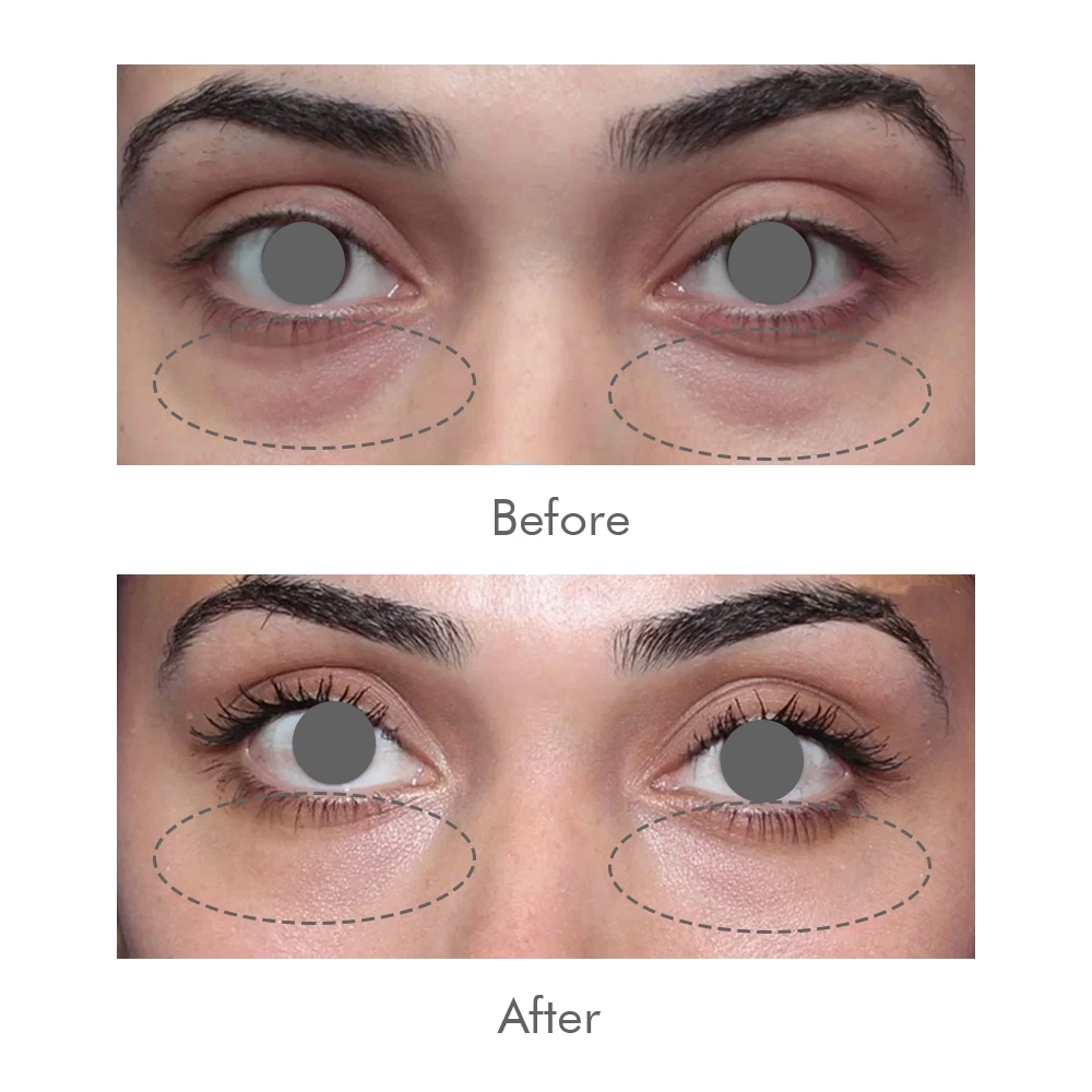 Cross Linked Hyaluronic Acid Injectable Gel Lip Augmentation Dermal Filler