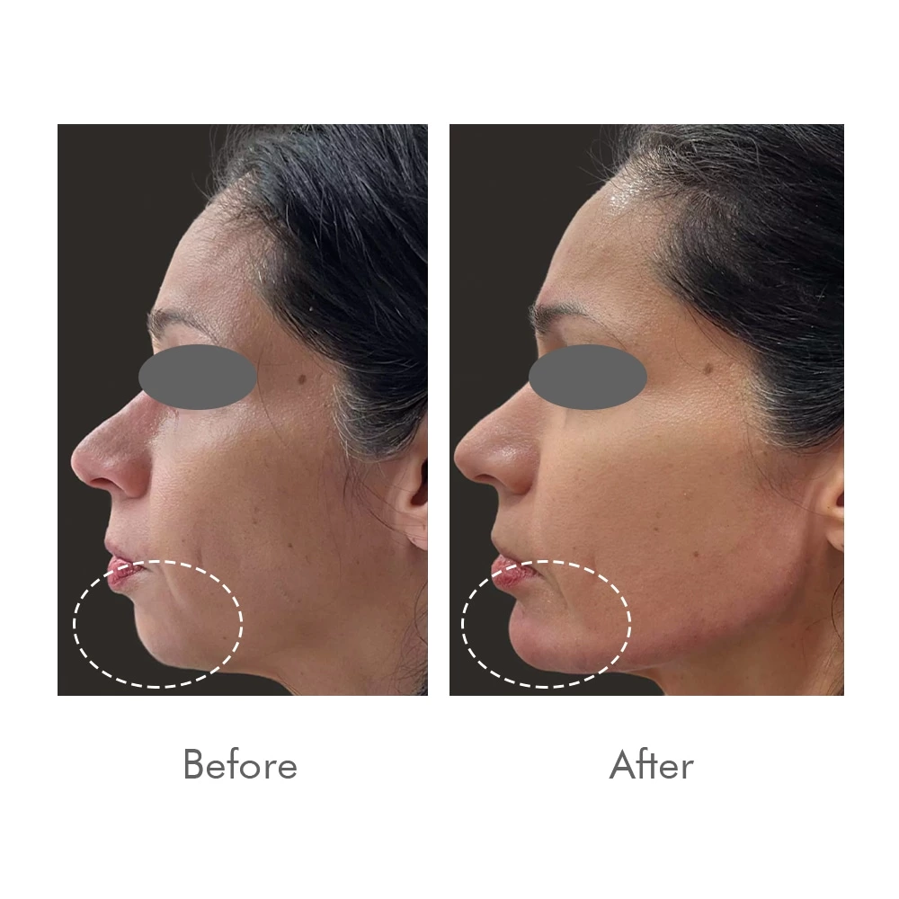 Cross Linked Hyaluronic Acid Injectable Gel Lip Augmentation Dermal Filler