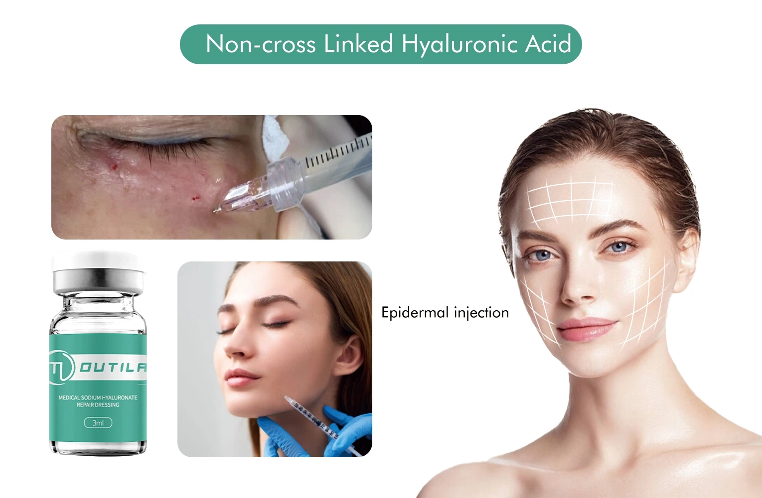 Cross Linked Hyaluronic Acid Injectable Gel Lip Augmentation Dermal Filler