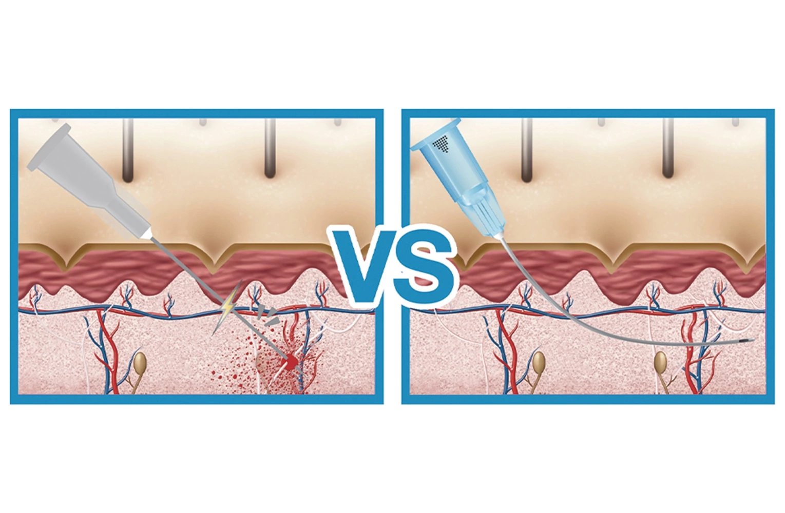Dermal Filler injection Micro Cannula