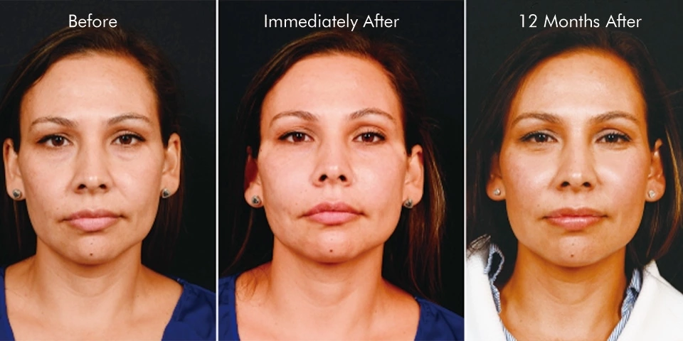 Long-Lasting Results