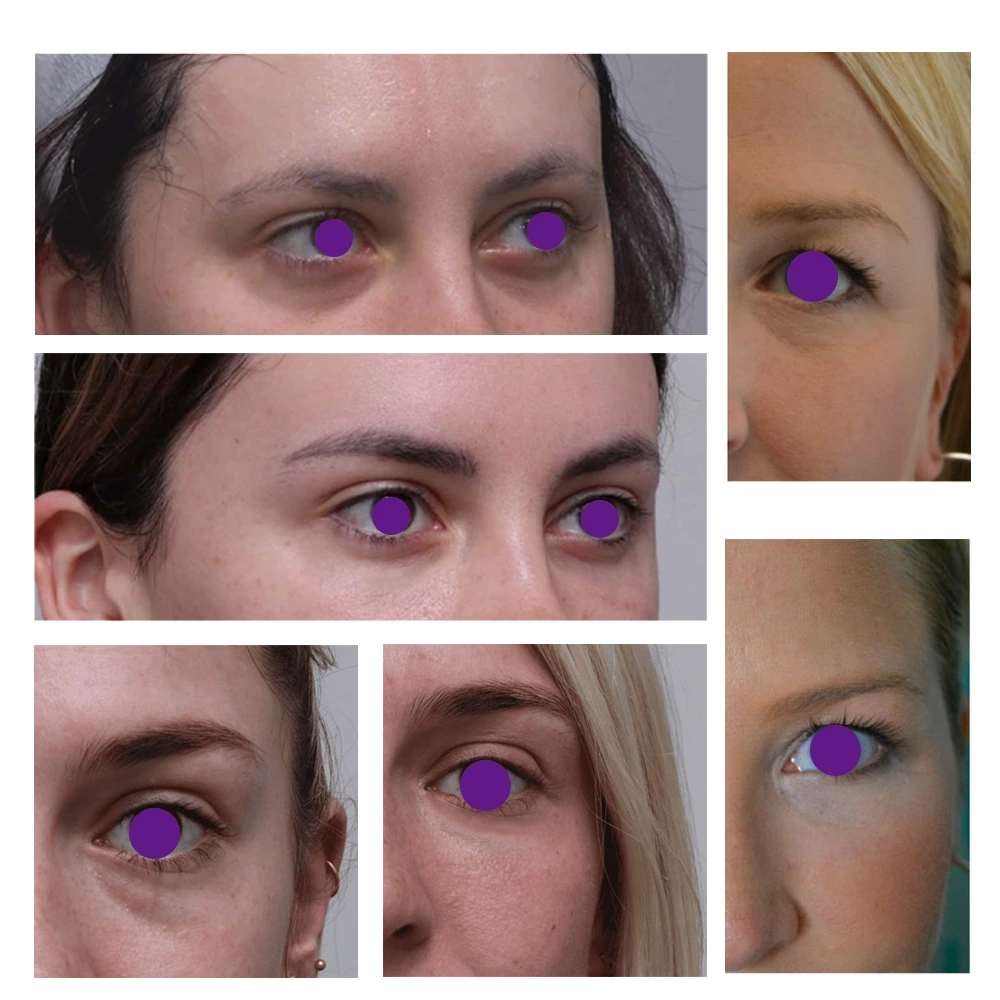PDO Eye Thread