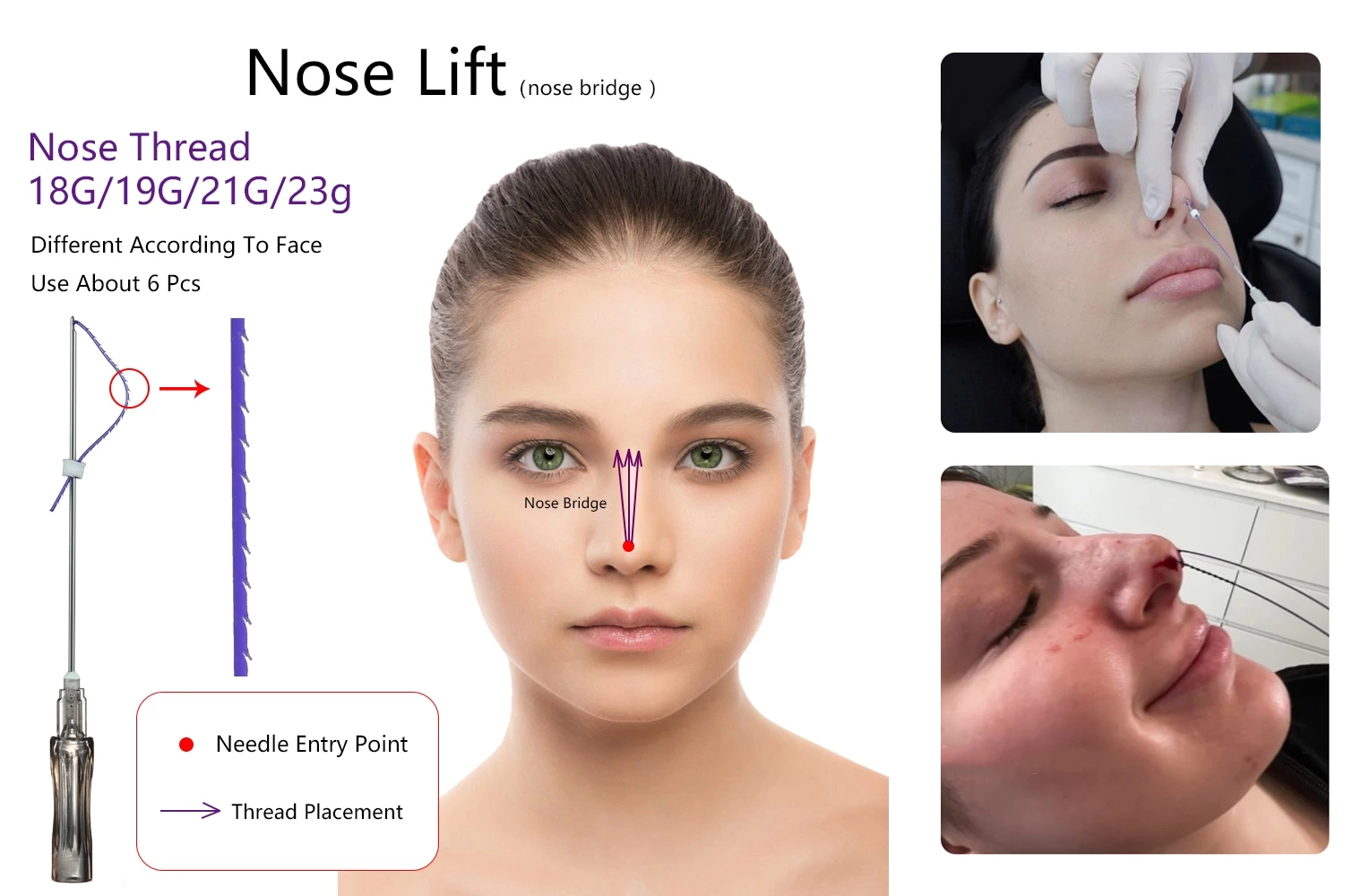 PDO Nose Thread