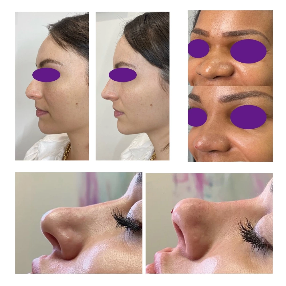 PDO Nose Thread
