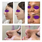 PDO Nose Thread