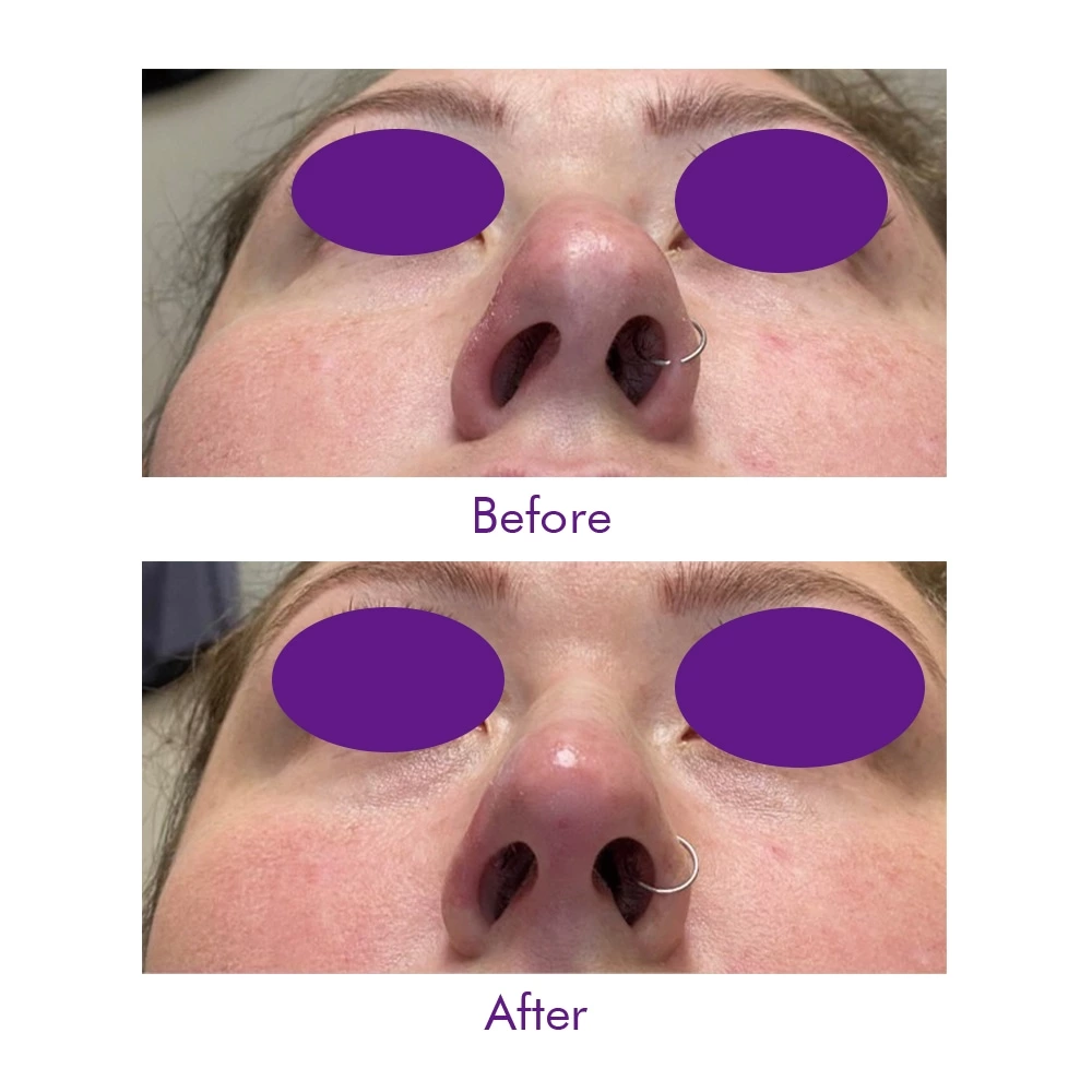 PDO Nose Thread
