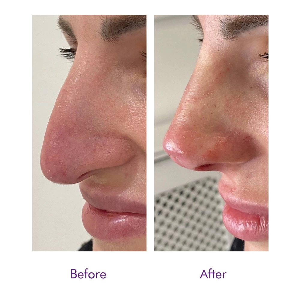 PDO Nose Thread