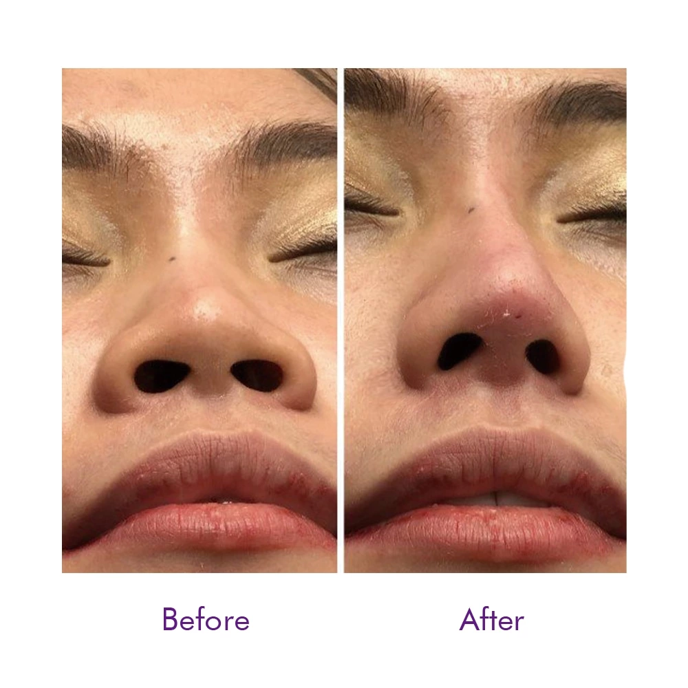 PDO Nose Thread