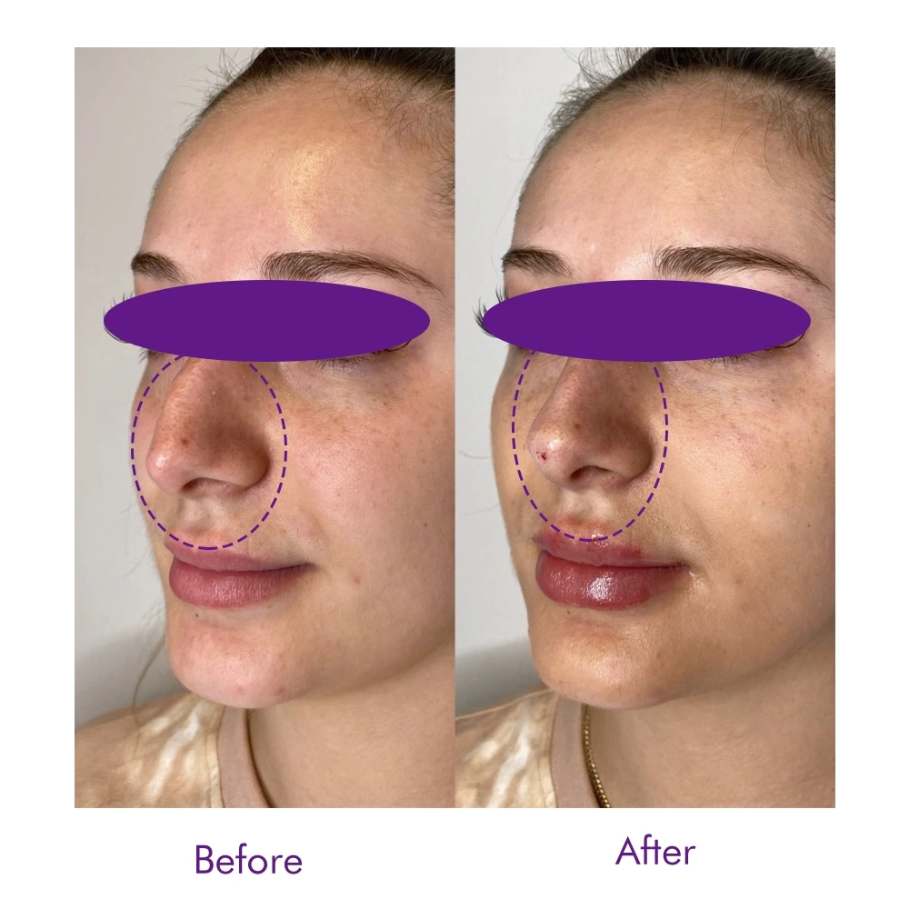 PDO Nose Thread