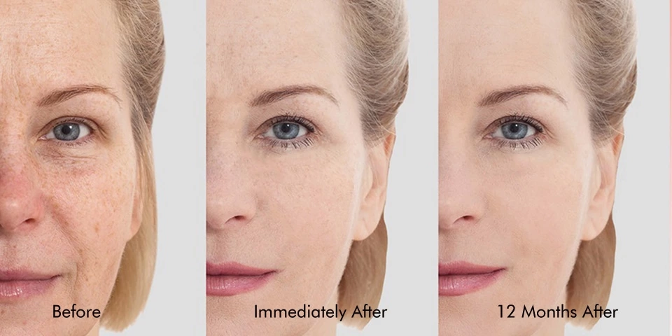 Reduces Fine Lines and Wrinkles
