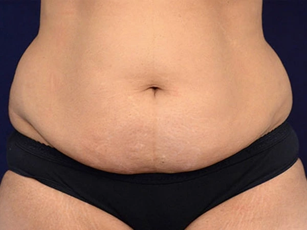 Filling &Lifting & Tightening