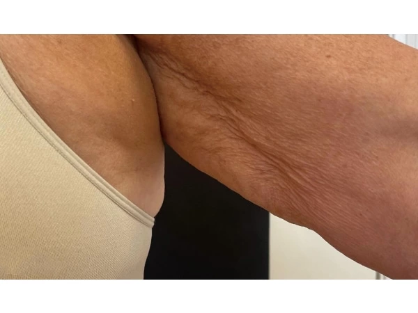 Filling &Lifting & Tightening