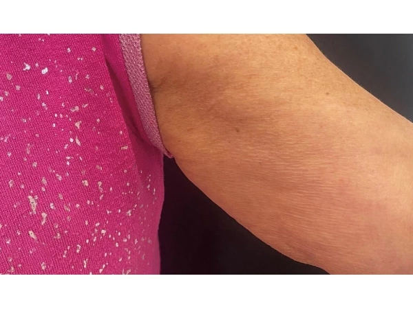 Filling &Lifting & Tightening