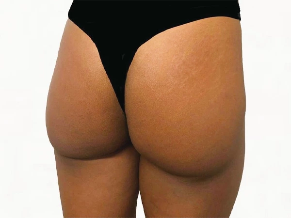 Skin Filling & Wrinkle Removal