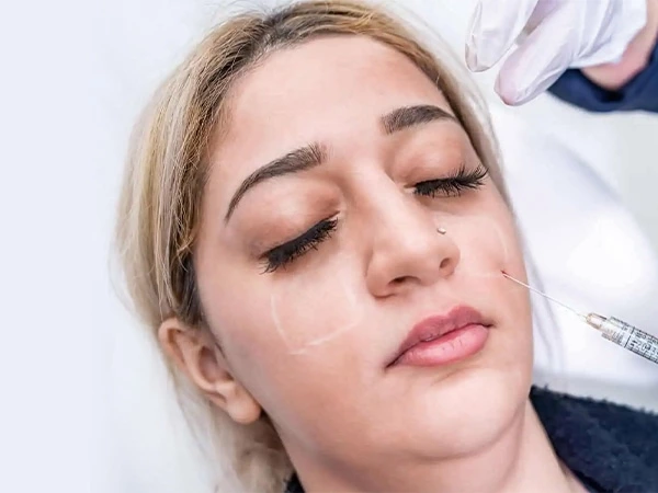 Injection Dermal Filler Needle