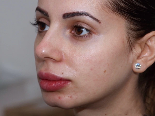 Skin Filling & Wrinkle Removal