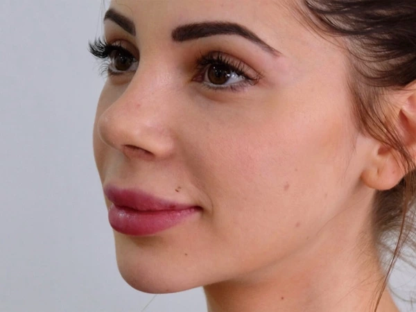 Skin Filling & Wrinkle Removal
