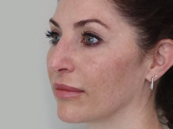 Filling &Lifting & Tightening