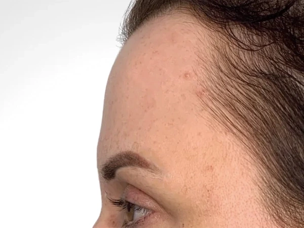 Skin Filling & Wrinkle Removal