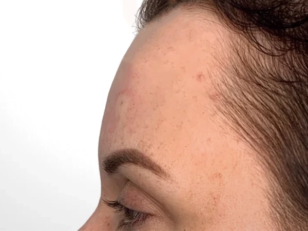 Skin Filling & Wrinkle Removal