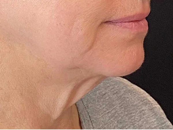 Filling &Lifting & Tightening