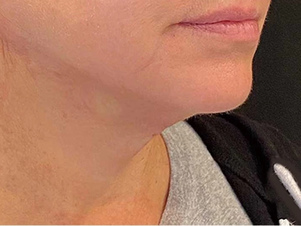 Filling &Lifting & Tightening