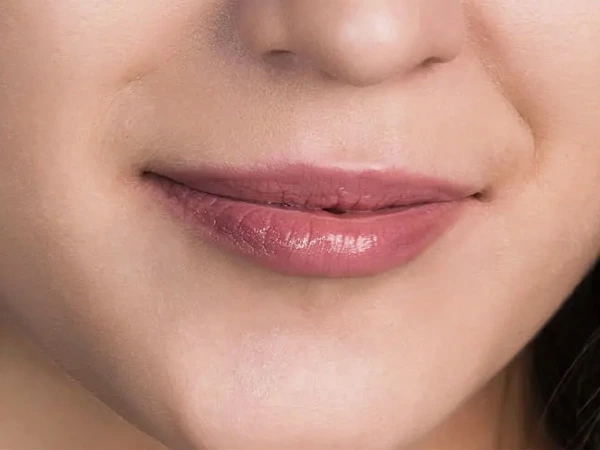Skin Filling & Wrinkle Removal